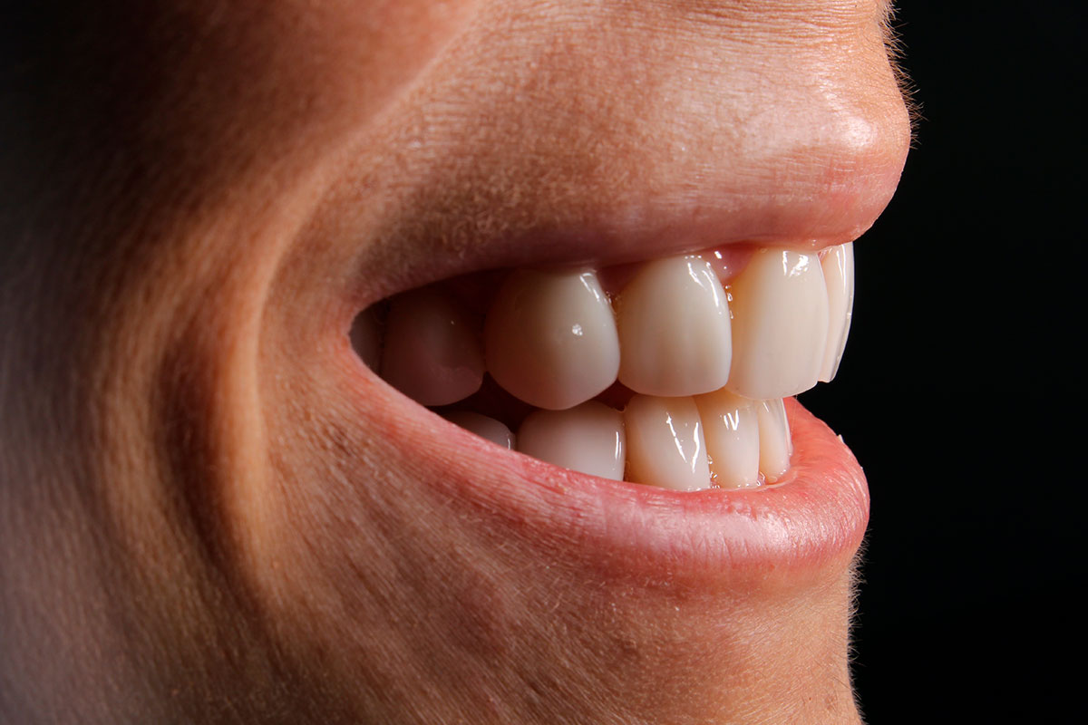 Mujer con carillas dentales